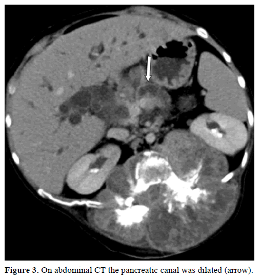 pancreas-on-abdominal-pancreatic