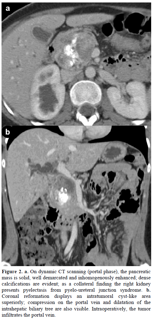 pancreas-on-dynamic-ct-scanning