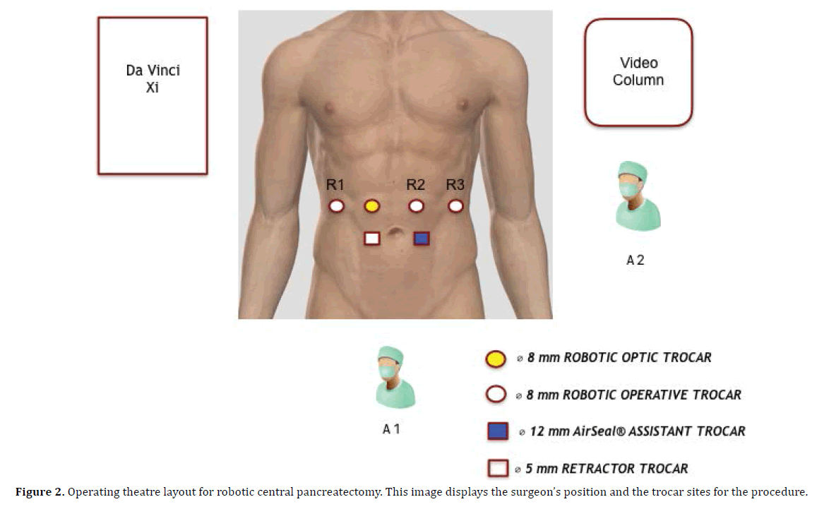 pancreas-operating-theatre-layout