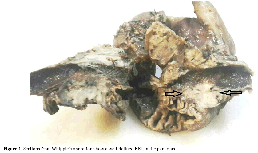 pancreas-operation