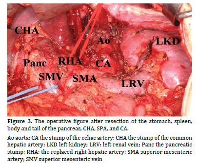 pancreas-operative