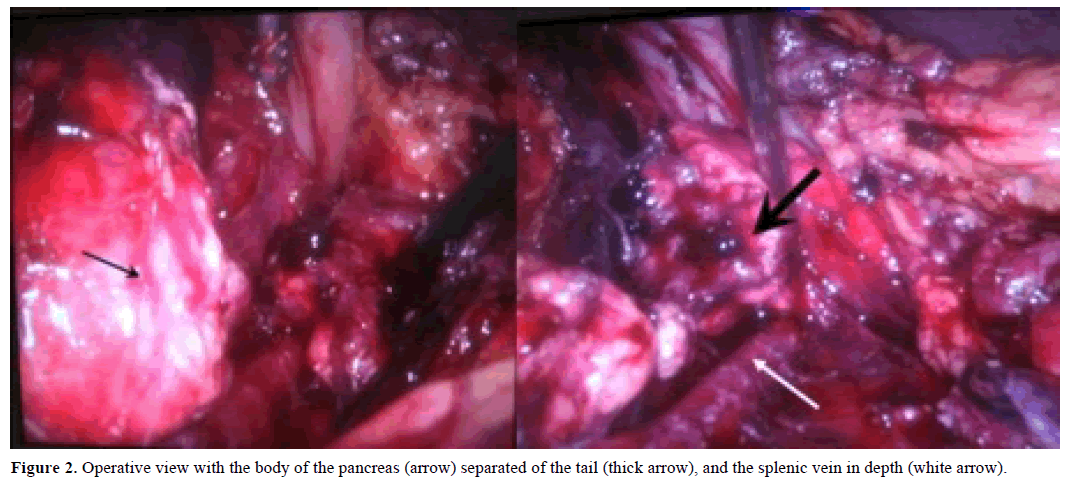 pancreas-operative-body-splenic-vein