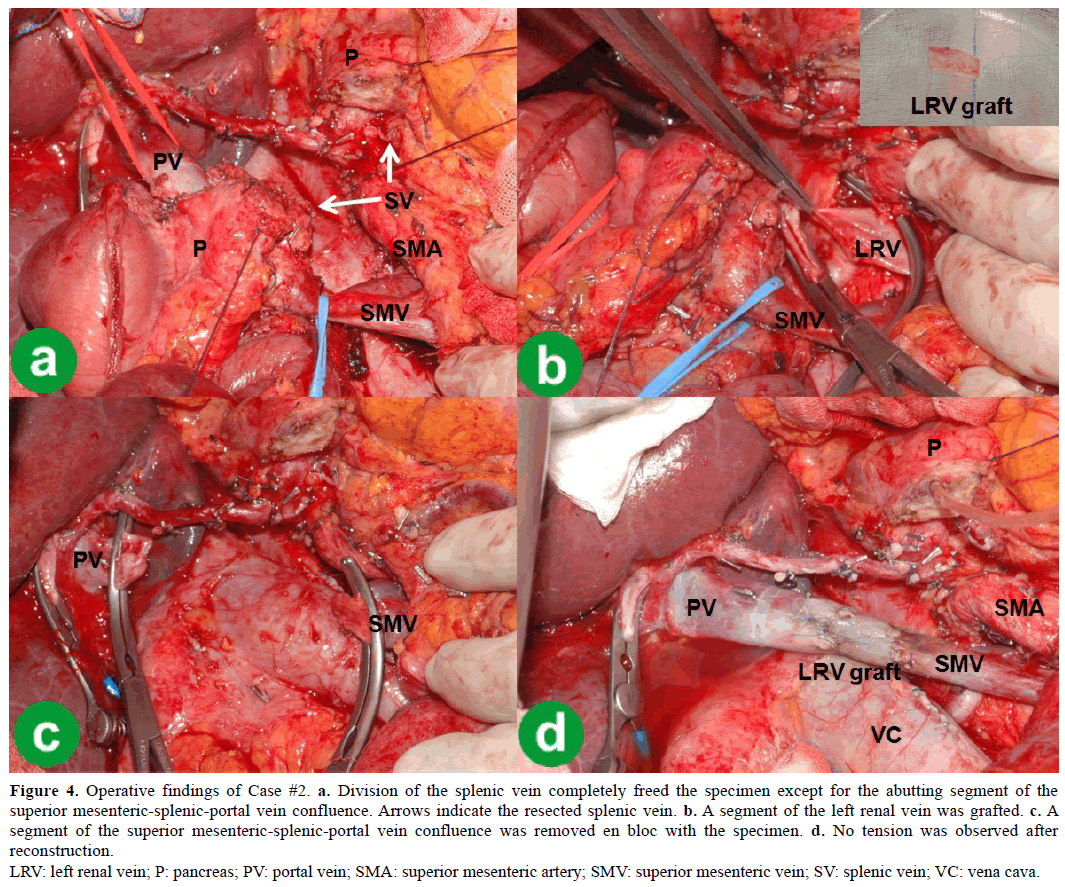 pancreas-operative-findings-case2