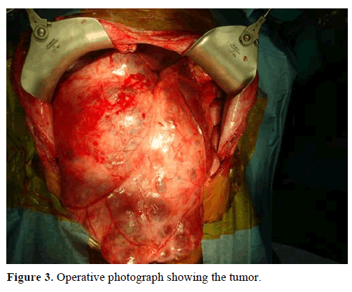 pancreas-operative-photograph-tumor
