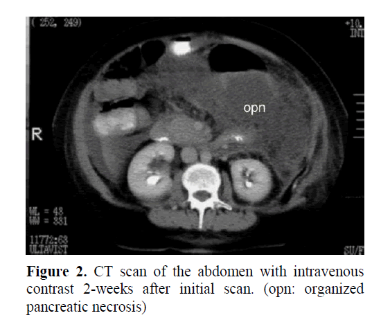 pancreas-organized-pancreatic-necrosis