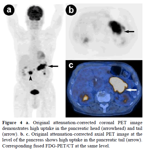 pancreas-original-attenuation-corrected