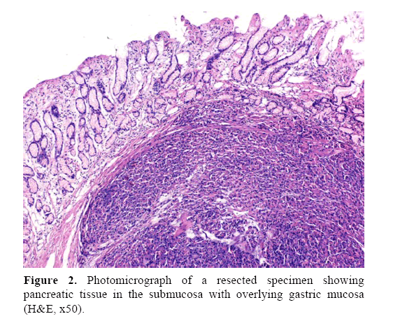pancreas-overlying-gastric-mucosa