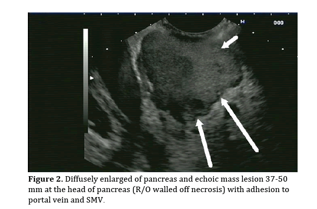 pancreas-pancreas-echoic-mass