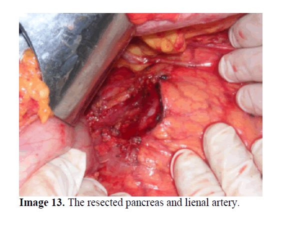 pancreas-pancreas-lienal-artery