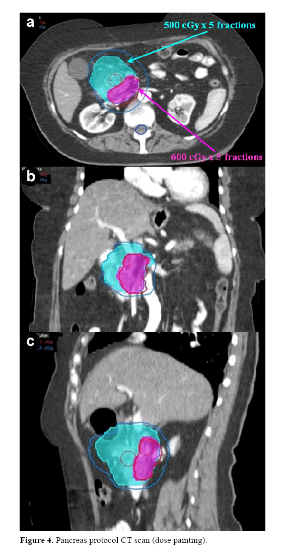 pancreas-pancreas-protocol-CT-scan