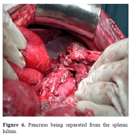 pancreas-pancreas-splenic-hilum