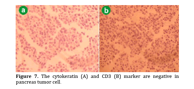 pancreas-pancreas-tumor-cell