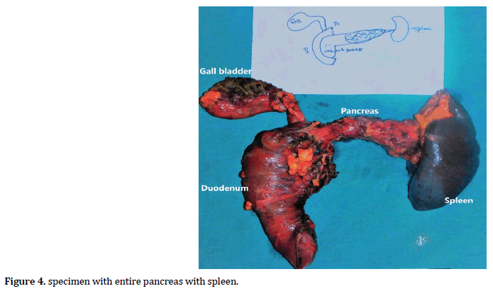 pancreas-pancreas-with-spleen