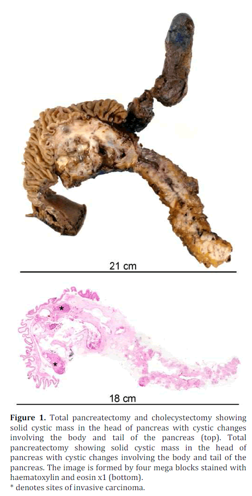 pancreas-pancreatectomy-cholecystectomy