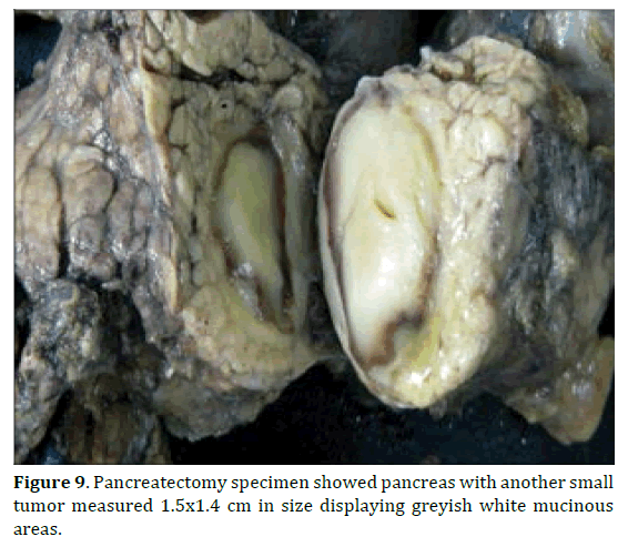 pancreas-pancreatectomy-pancreas-mucinous