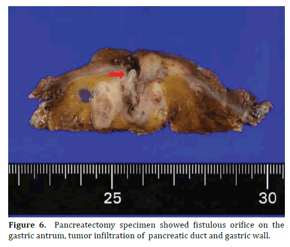 pancreas-pancreatectomy-specimen