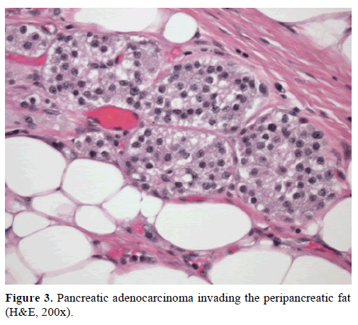 pancreas-pancreatic-adenocarcinoma