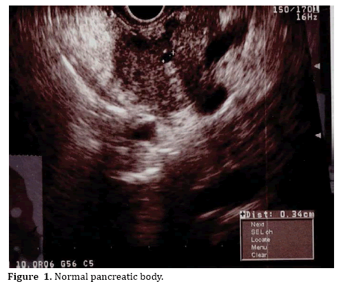 pancreas-pancreatic-body