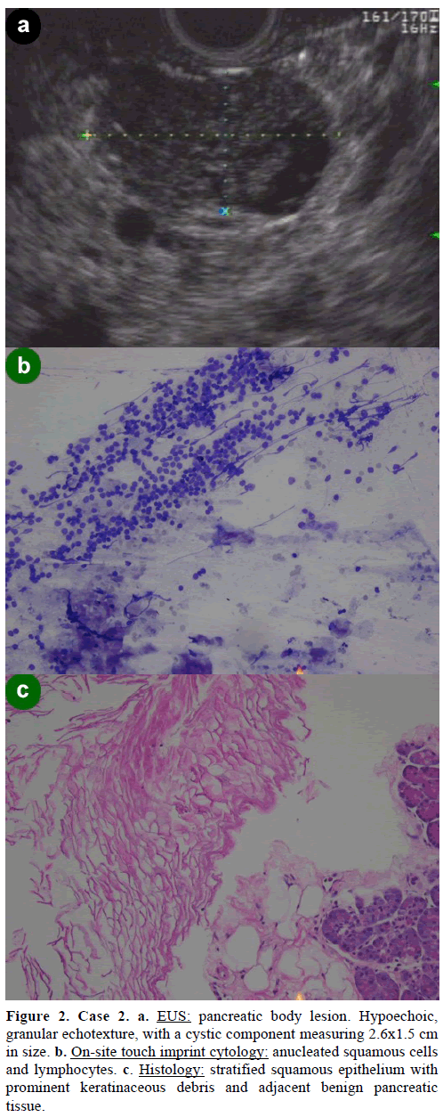 pancreas-pancreatic-body-lesion