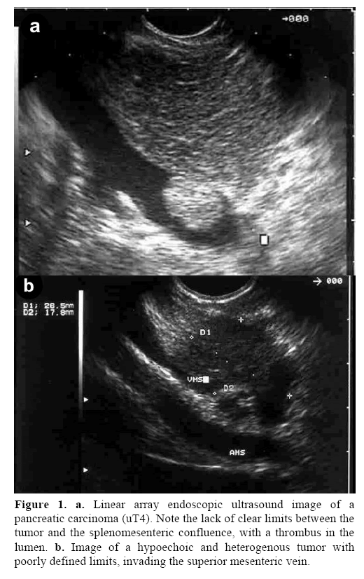 pancreas-pancreatic-carcinoma