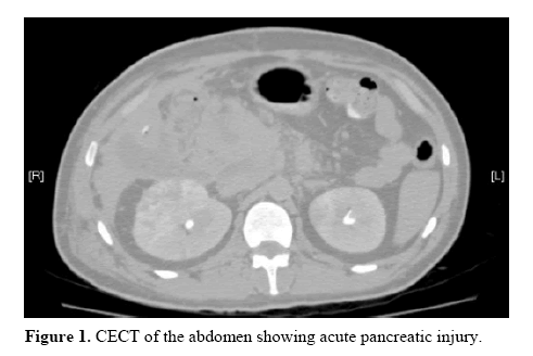 pancreas-pancreatic-carcinoma