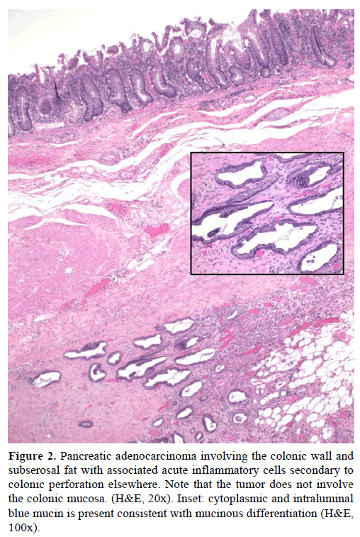 pancreas-pancreatic-colonic-wall