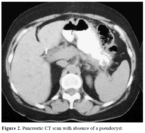 pancreas-pancreatic-ct-scan-pseudocyst