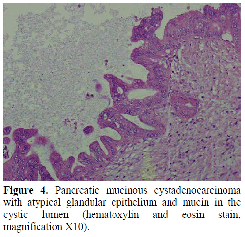 pancreas-pancreatic-cystadenocarcinoma