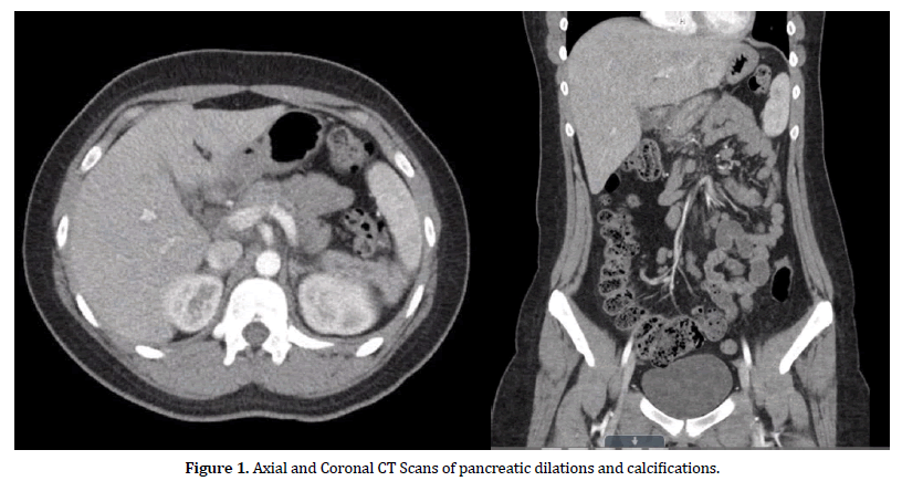 pancreas-pancreatic-dilations