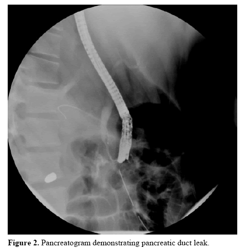 pancreas-pancreatic-duct-leak