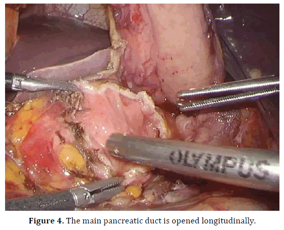 pancreas-pancreatic-duct-longitudinally