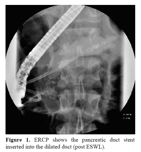 pancreas-pancreatic-duct-stents