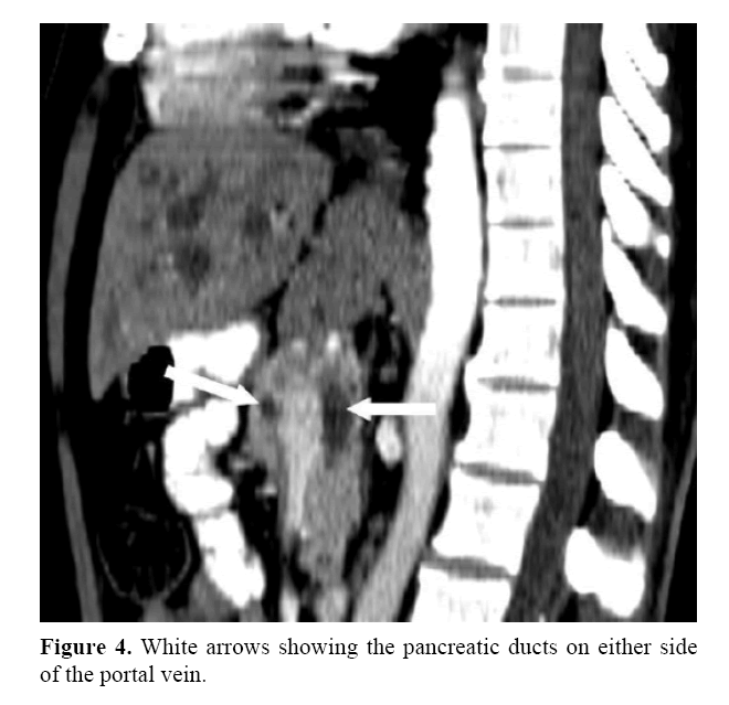 pancreas-pancreatic-ducts-either