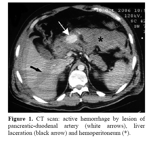 pancreas-pancreatic-duodenal-artery