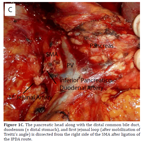 pancreas-pancreatic-head-distal