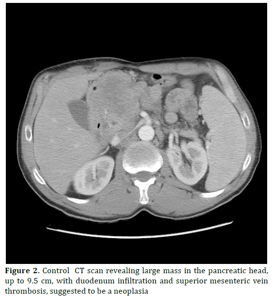 pancreas-pancreatic-head-duodenum