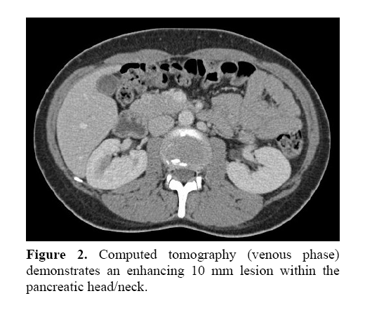 pancreas-pancreatic-head-neck