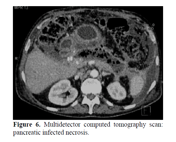 pancreas-pancreatic-infected-necrosis