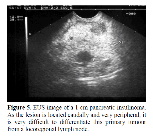 pancreas-pancreatic-insulinoma