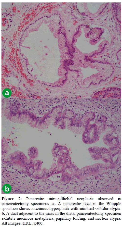 pancreas-pancreatic-intraepithelial-neoplasia