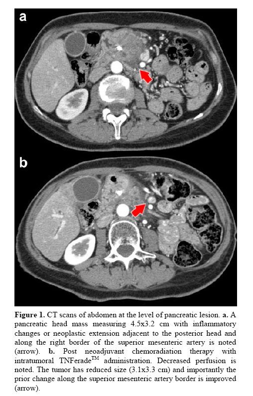 pancreas-pancreatic-lesion