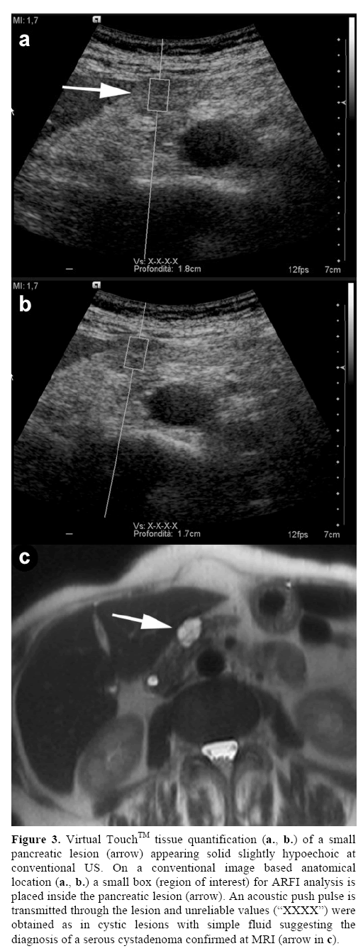 pancreas-pancreatic-lesion