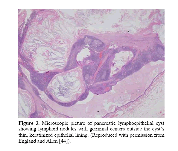 pancreas-pancreatic-lymphoepithelial-cyst