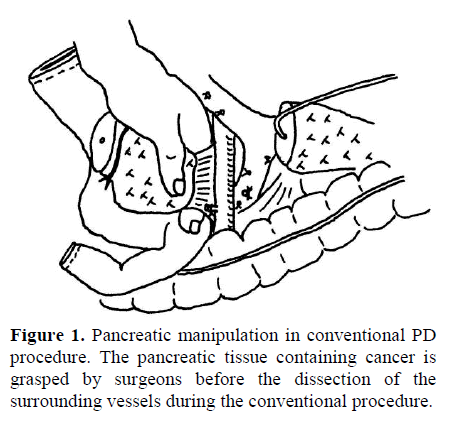pancreas-pancreatic-manipulation-conventional