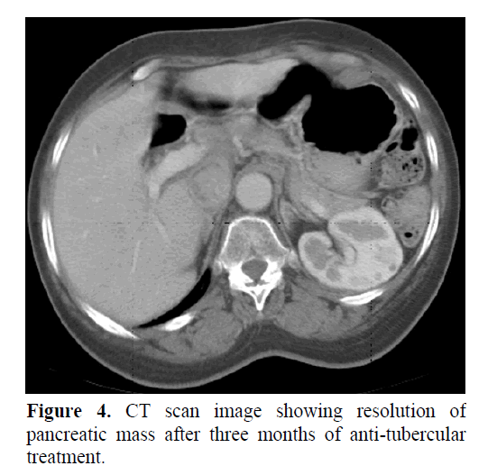 pancreas-pancreatic-mass-after-three-months