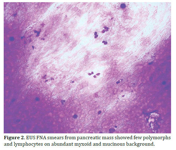 pancreas-pancreatic-mass-polymorphs