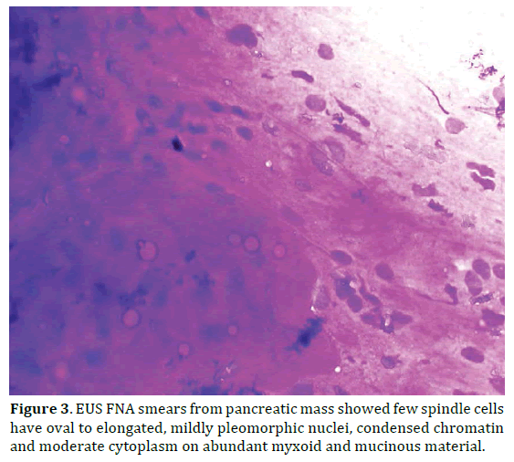 pancreas-pancreatic-mass-spindle