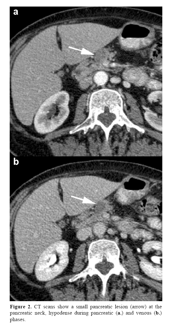 pancreas-pancreatic-neck