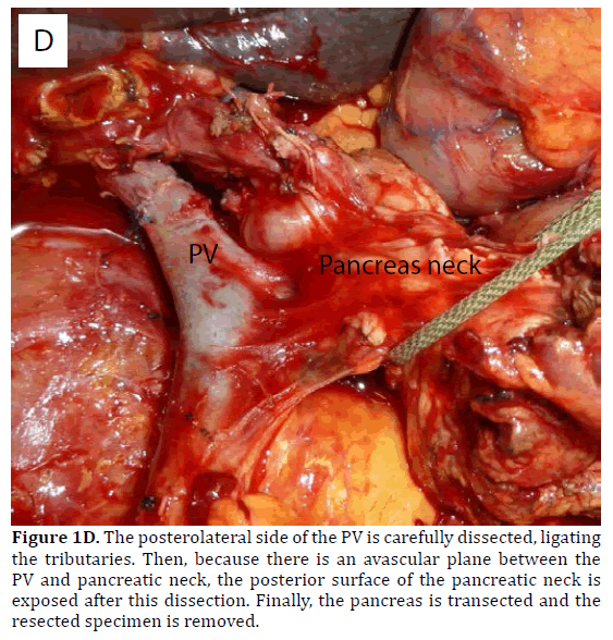 pancreas-pancreatic-neck-dissection