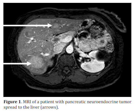pancreas-pancreatic-neuroendocrine-tumor